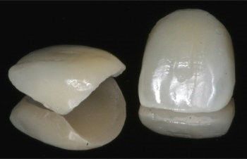 Veneers Gurgaon Veneers Gurgaon