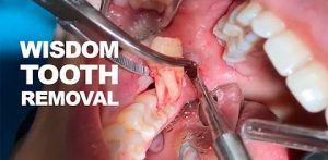 Wisdom Tooth Extraction