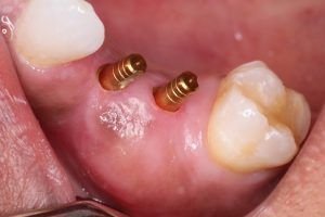 What are Implant Failure Causes