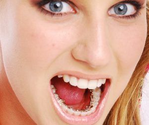 Lingual Braces in Gurgaon