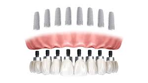 All-on-8 Dental Implant System