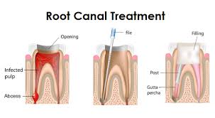 Root Canal Therapy