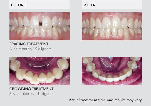clear aligners cost