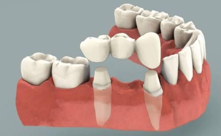 Dental Bridges in Gurugram