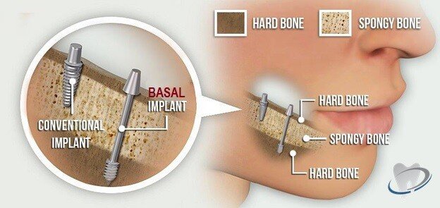 Basal Implants vs Conventional Implants 