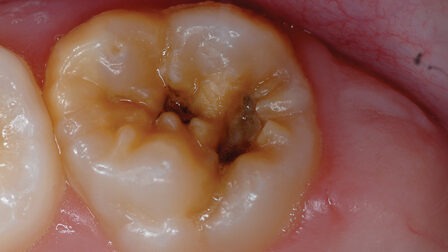 Dental Cavities