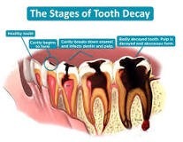 Tooth Decay