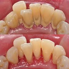 Dental Scaling