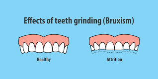 Bruxism Treatment