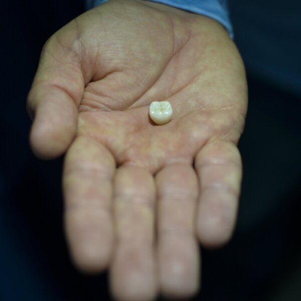 My Tooth Cap Came Off