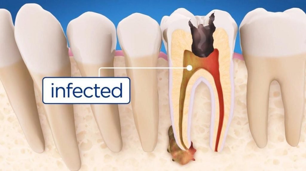 Root Canal Treatment Alternatives