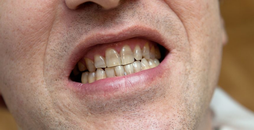 smokers Teeth