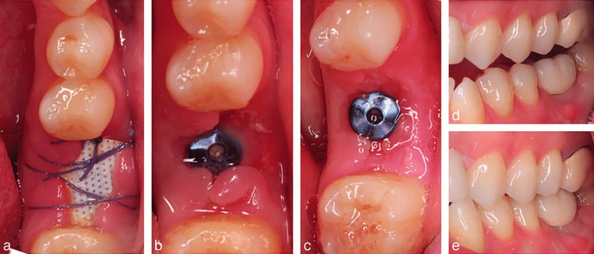 Dental Implant Healing Stages